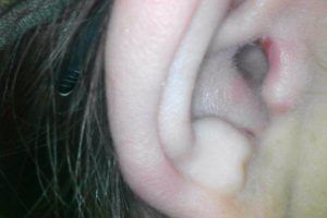 ear with sores around the canal